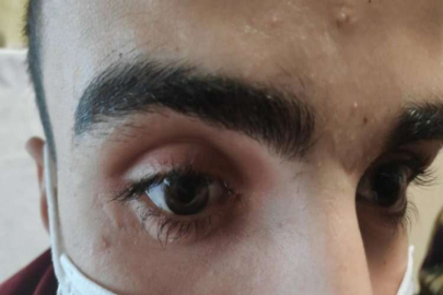 Gözünde unutulan cam kırığı ile bir ay yaşadı