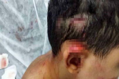 Köpeğin saldırısına uğrayan çocuğun kafasında derin yaralar oluştu
