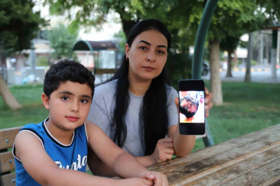 Sokak köpeği saldırısında ağır yaralanan çocuktan ’köpekler toplansın’ çağrısı
