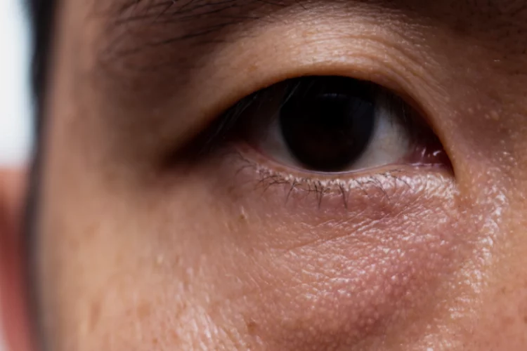 Göz Kapağının Normalin Aksine Göz Bebeğinin Yarısını Örtecek Şekilde Sarkması: Göz Kapağı Düşüklüğü