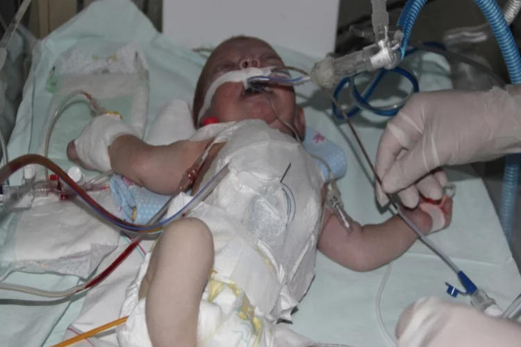 Suriyeli bebeğe, Gaziantep'te suni damar dikildi